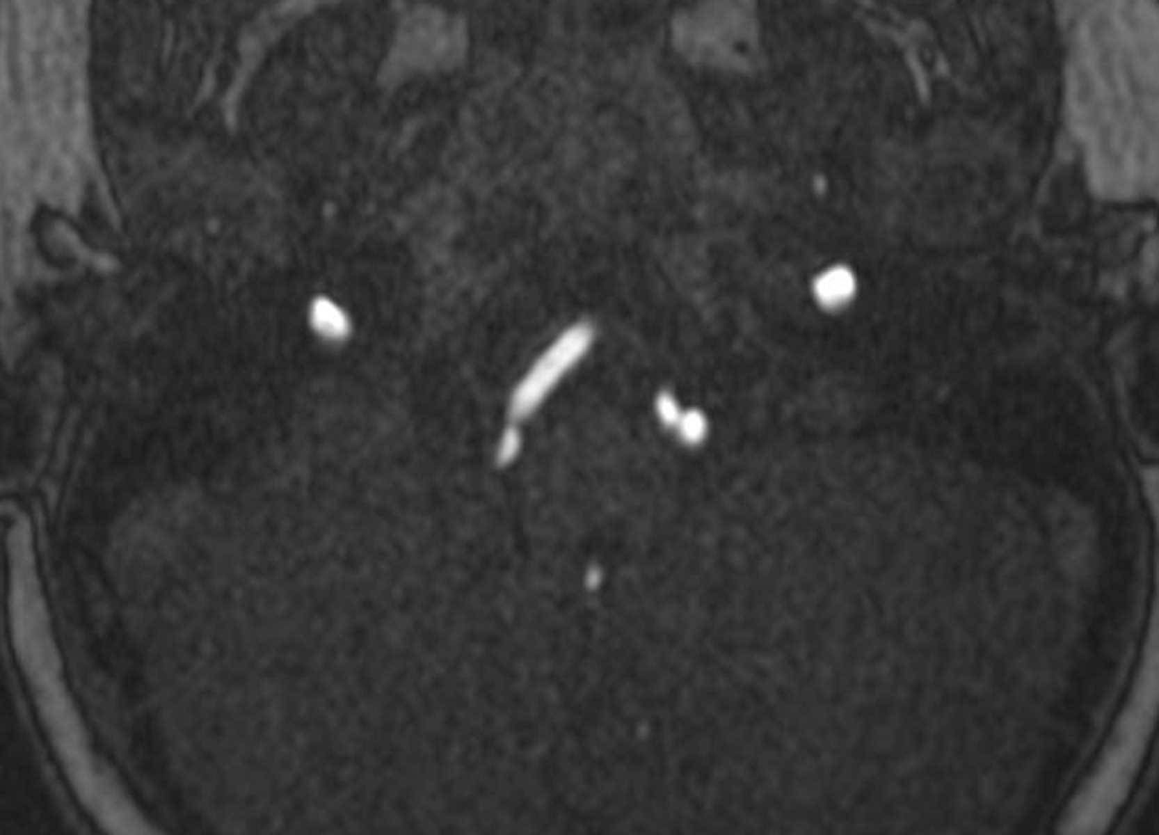 Fenestration - CTisus CT Scan