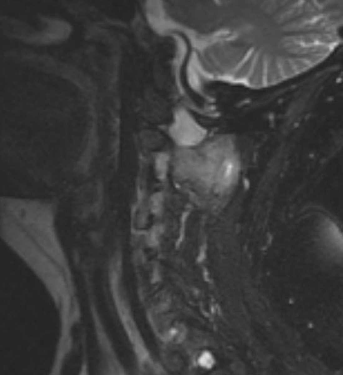 Metastases- spine, thyroid - CTisus CT Scan