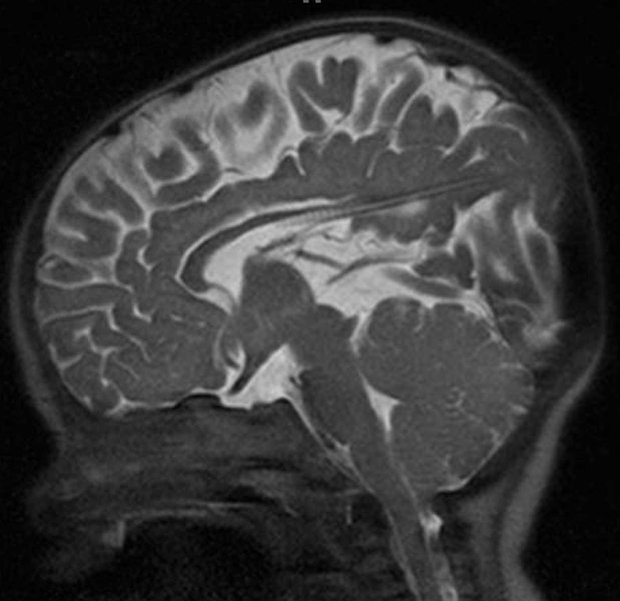 Chiari II Malformation - CTisus CT Scan