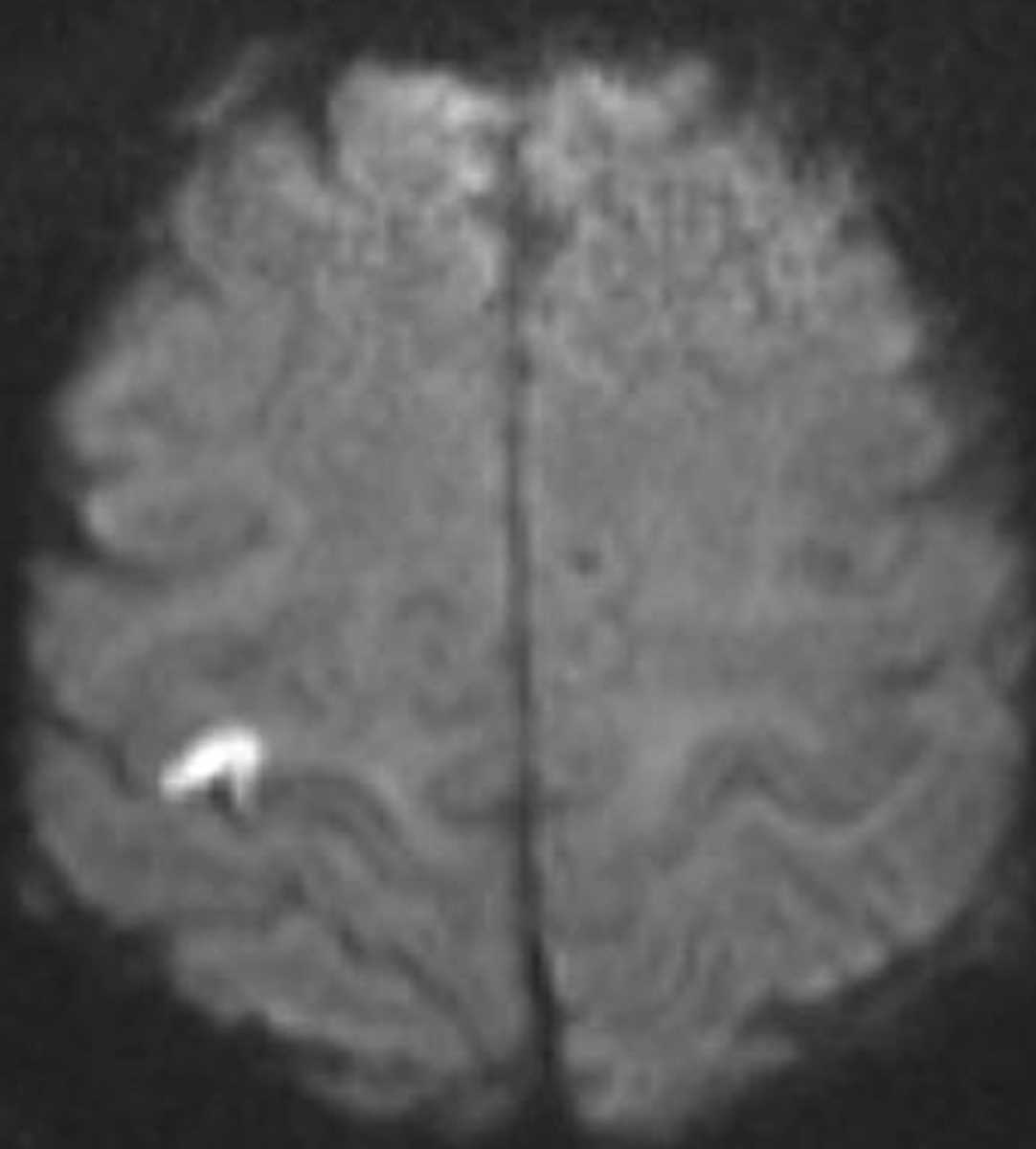 Infarction (Right MCA) - CTisus CT Scan