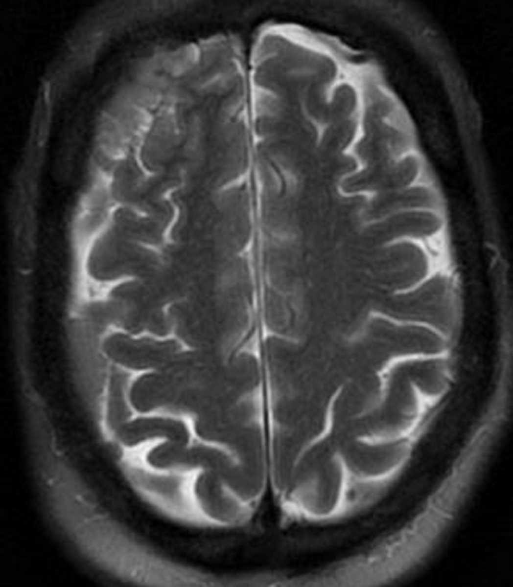 Metastases (Prostate Cancer) - CTisus CT Scan