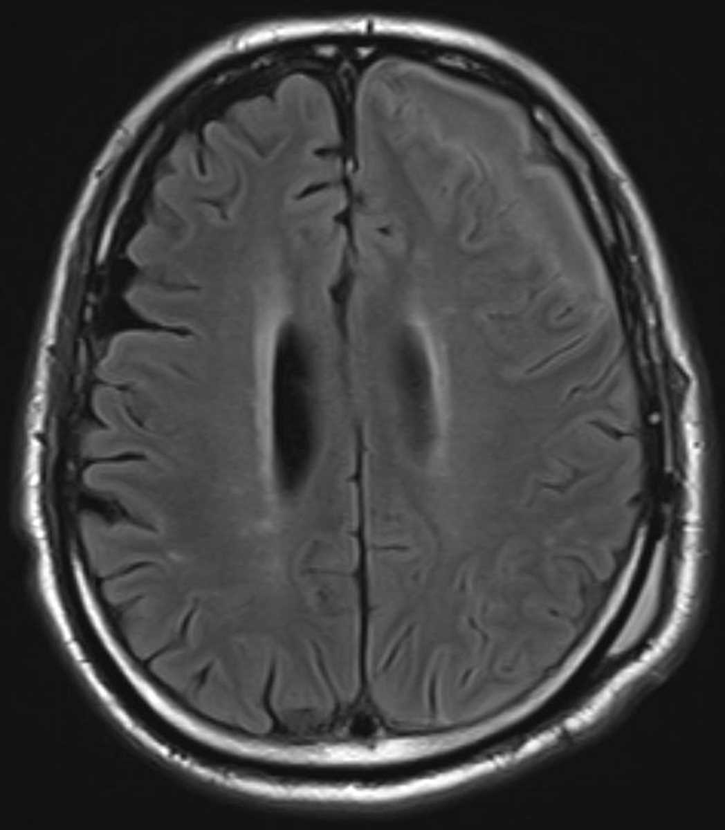 Subdural Empyema - CTisus CT Scan