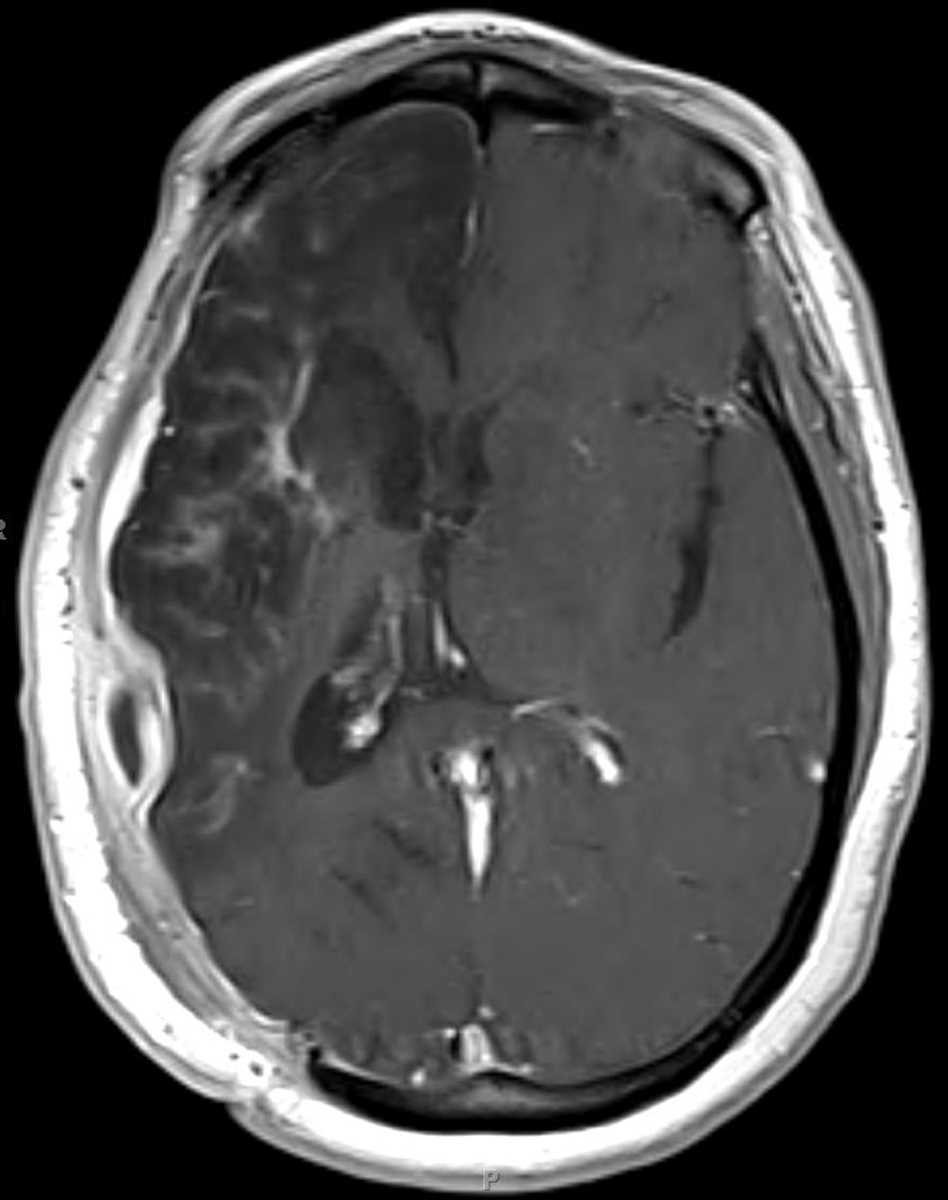 Craniotomy Bone Flap (Complications) - CTisus CT Scan