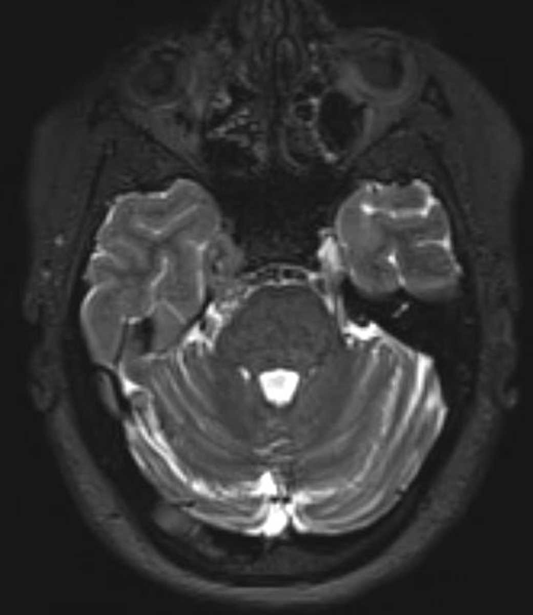 Schwannoma (Trigeminal) - CTisus CT Scan