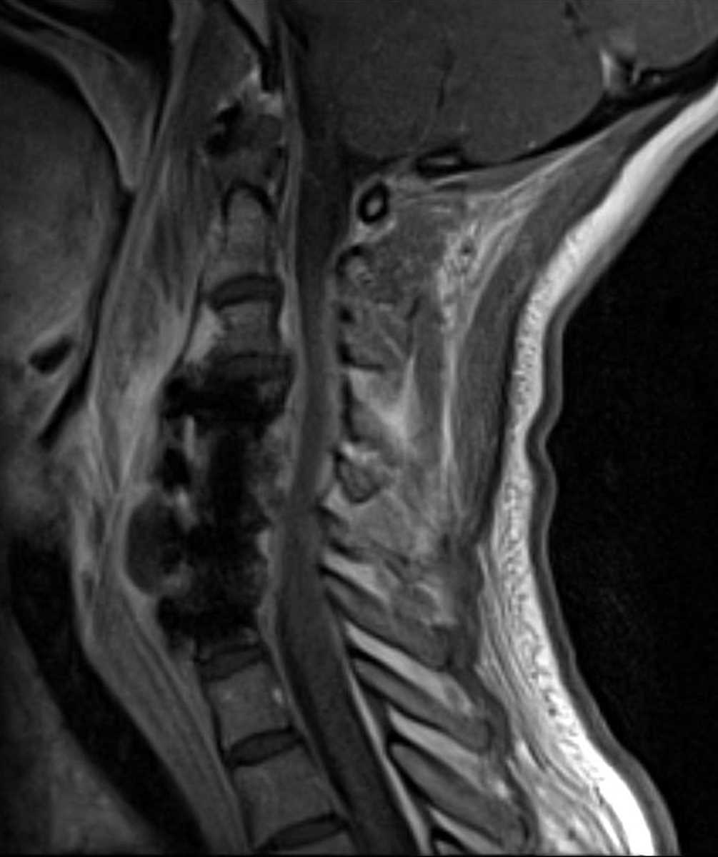 Abscess (Prevertebral) (Hardware Infection) - CTisus CT Scan