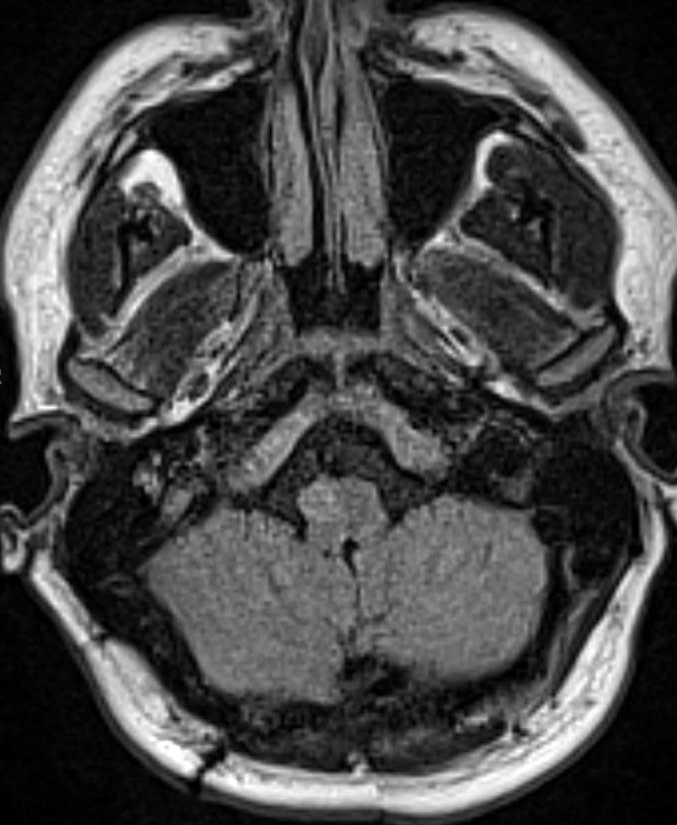 Hypertrophic Olivary Degeneration - CTisus CT Scan