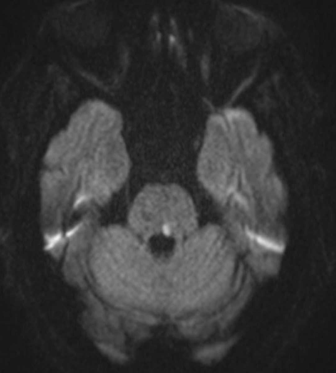 Infarct (Medial Longitudinal Fasciculus) - CTisus CT Scan