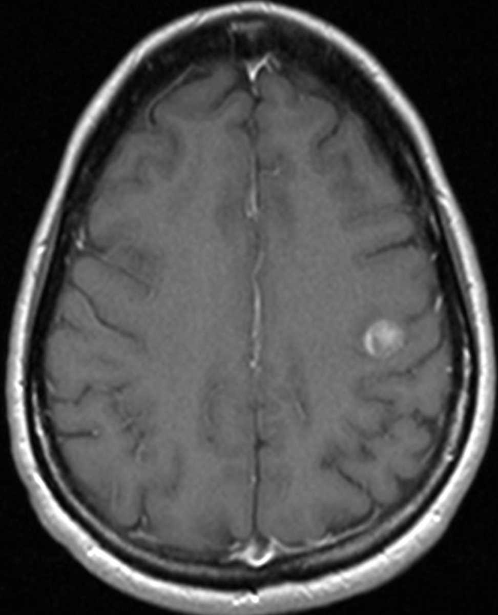 Metastases (Cerebral) - CTisus CT Scan