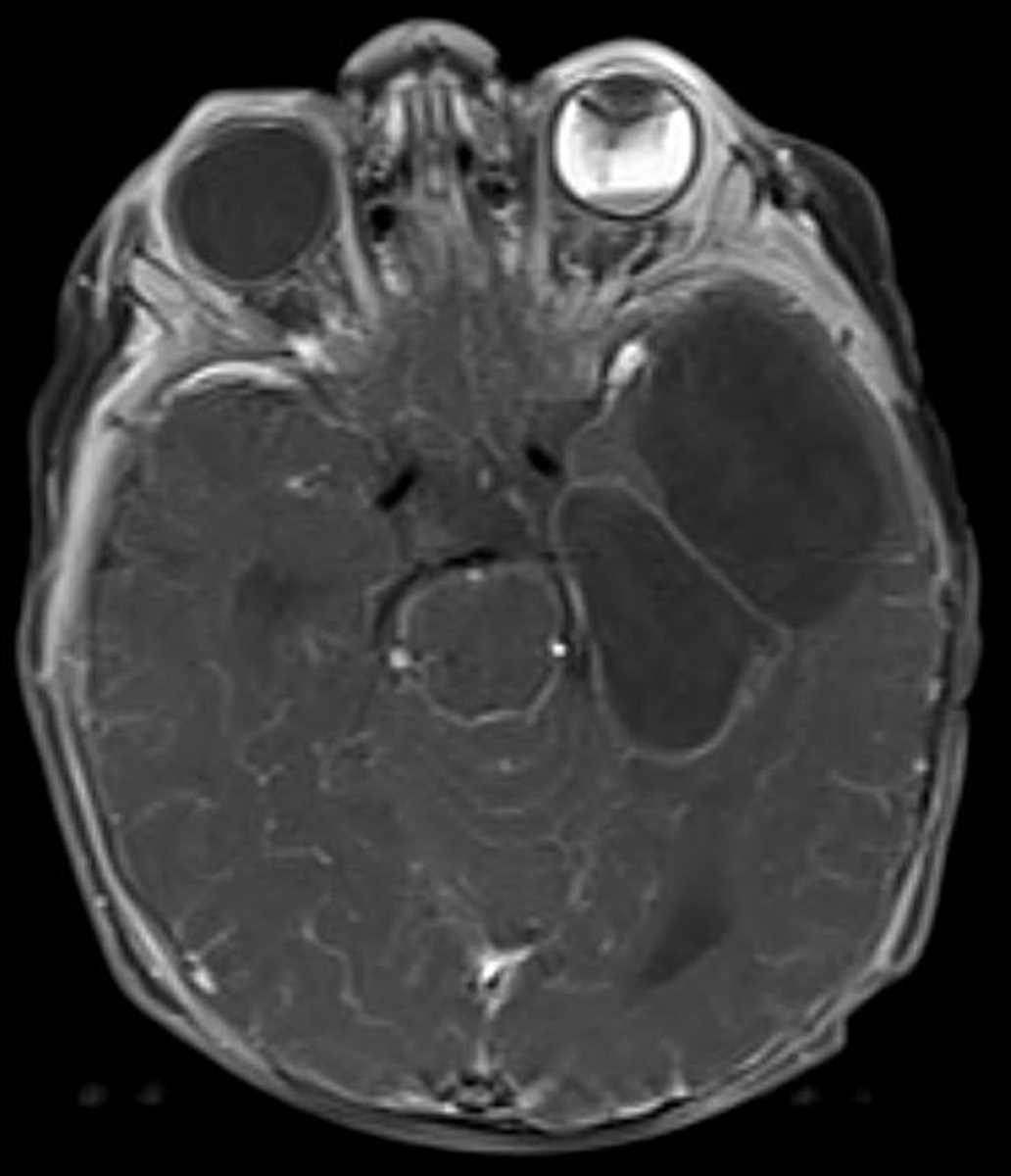 Persistent Hyperplastic Vitreous - CTisus CT Scan