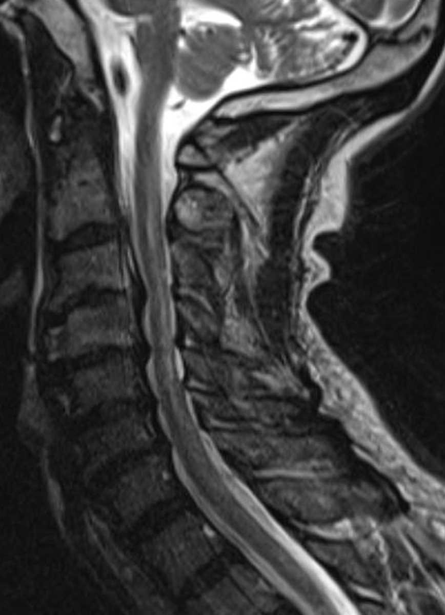 Subacute Combined Degeneration - CTisus CT Scan