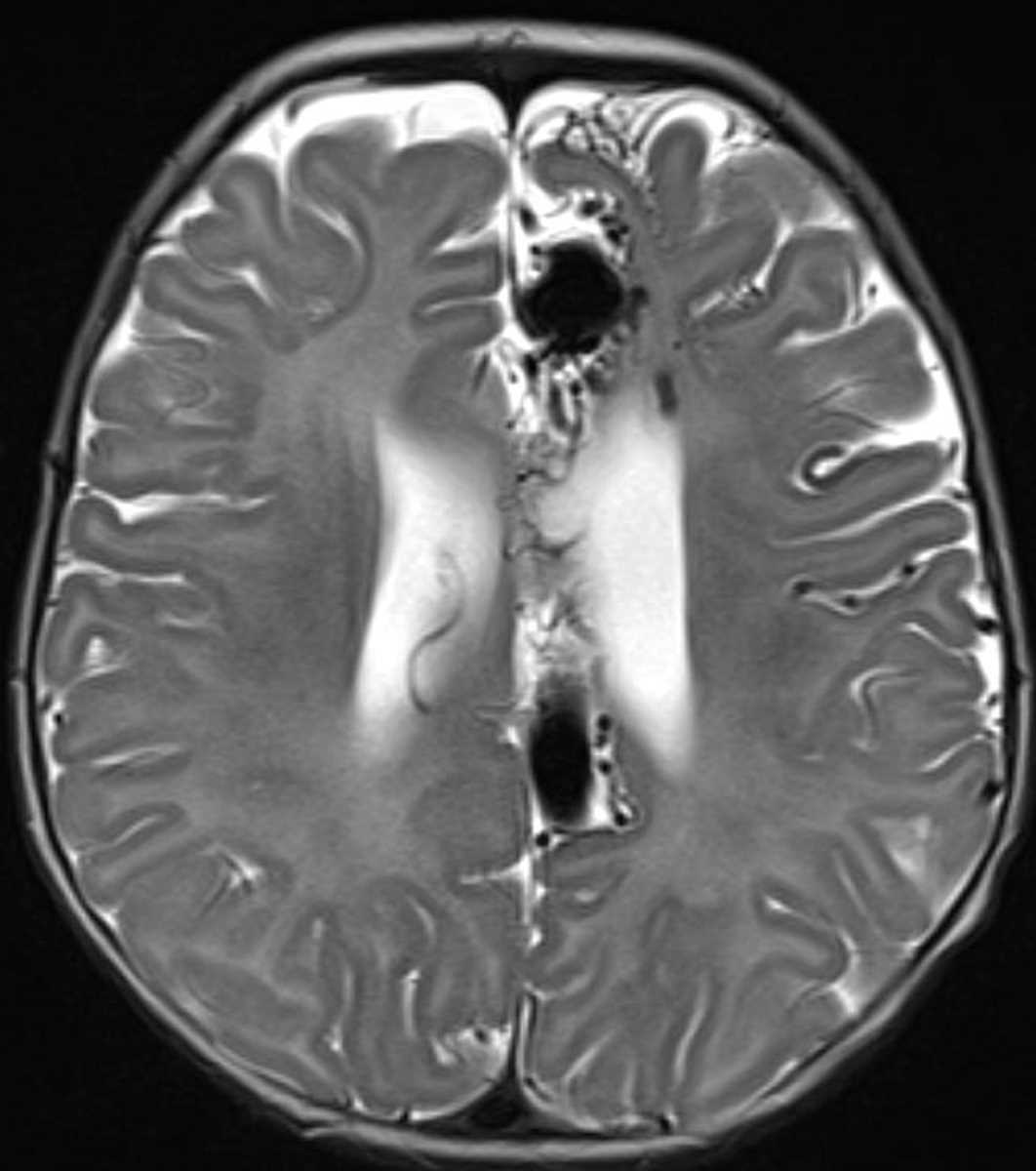 Arteriovenous Malformation - CTisus CT Scan
