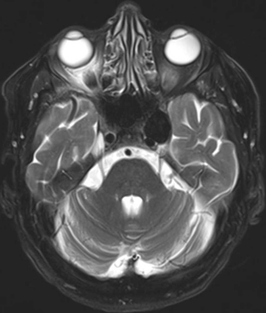 Cavernous Carotid Aneurysms - CTisus CT Scan
