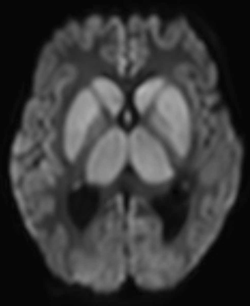 Hypoxic Ischemic Encephalopathy - CTisus CT Scan