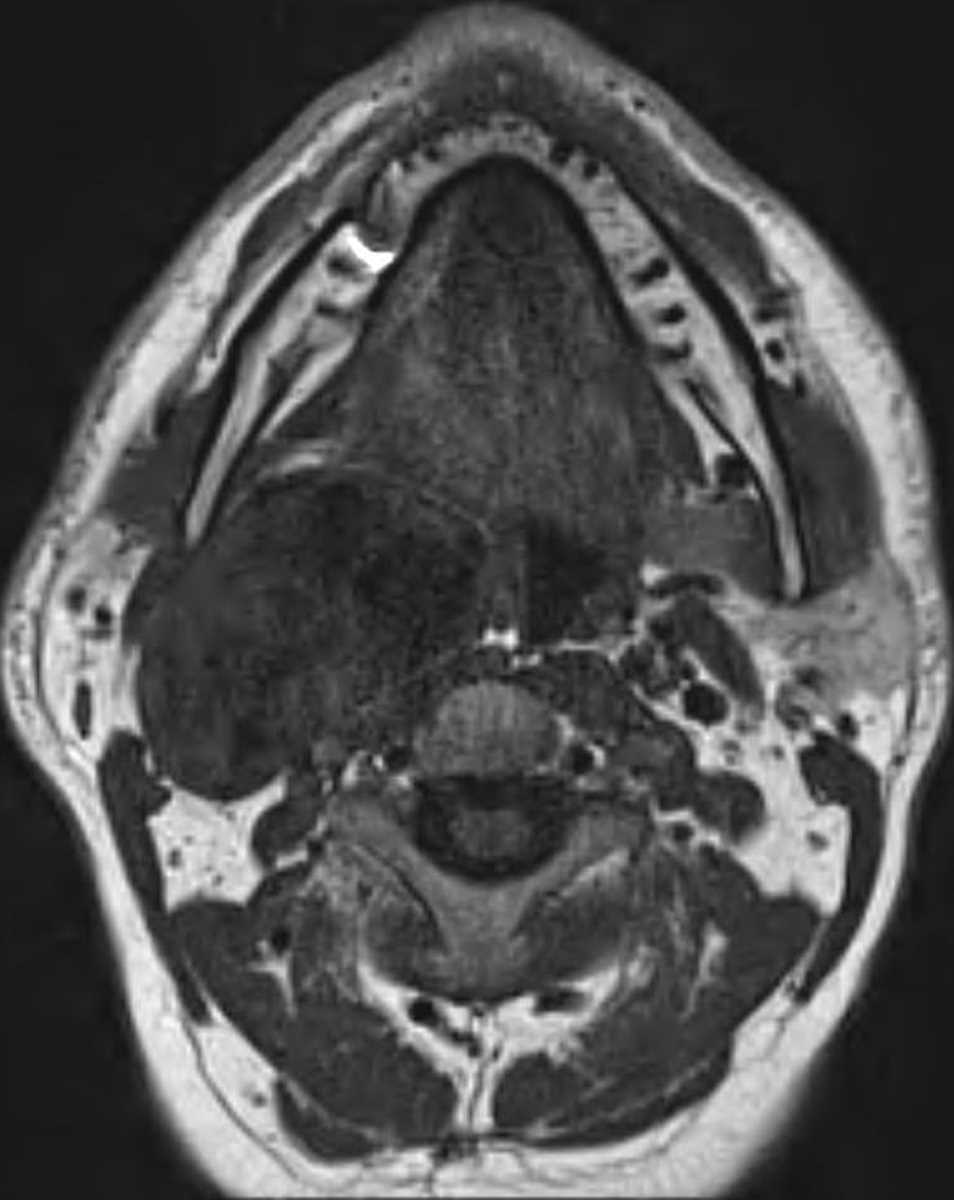 Schwannoma (Carotid Space) - CTisus CT Scan