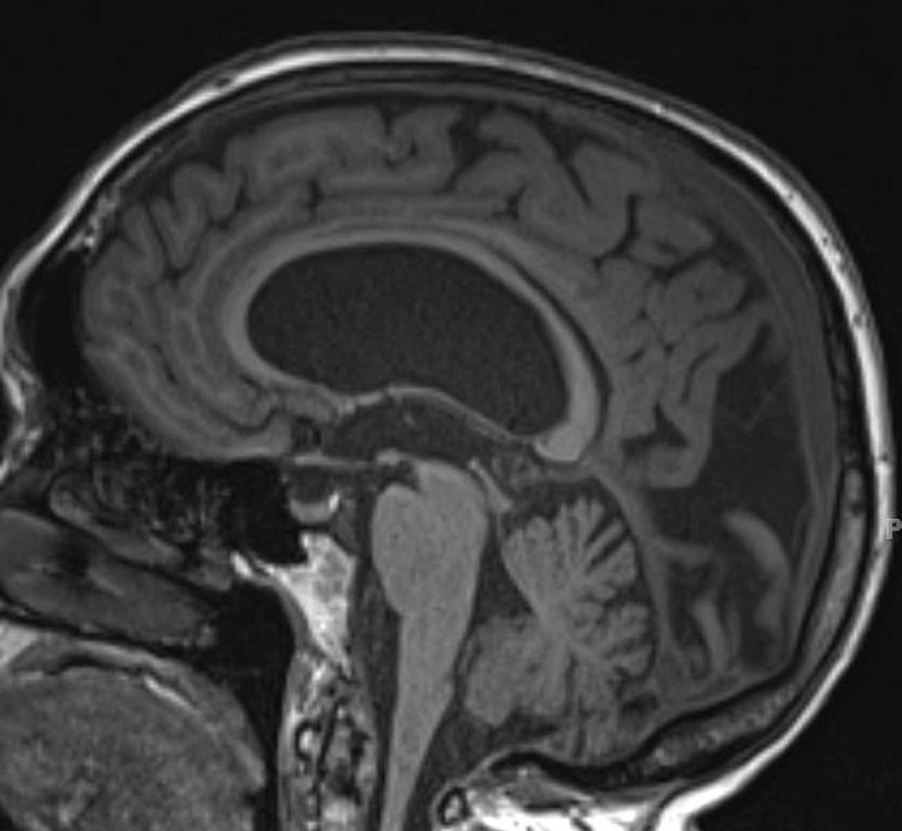 Normal Pressure Hydrocephalus - CTisus CT Scan