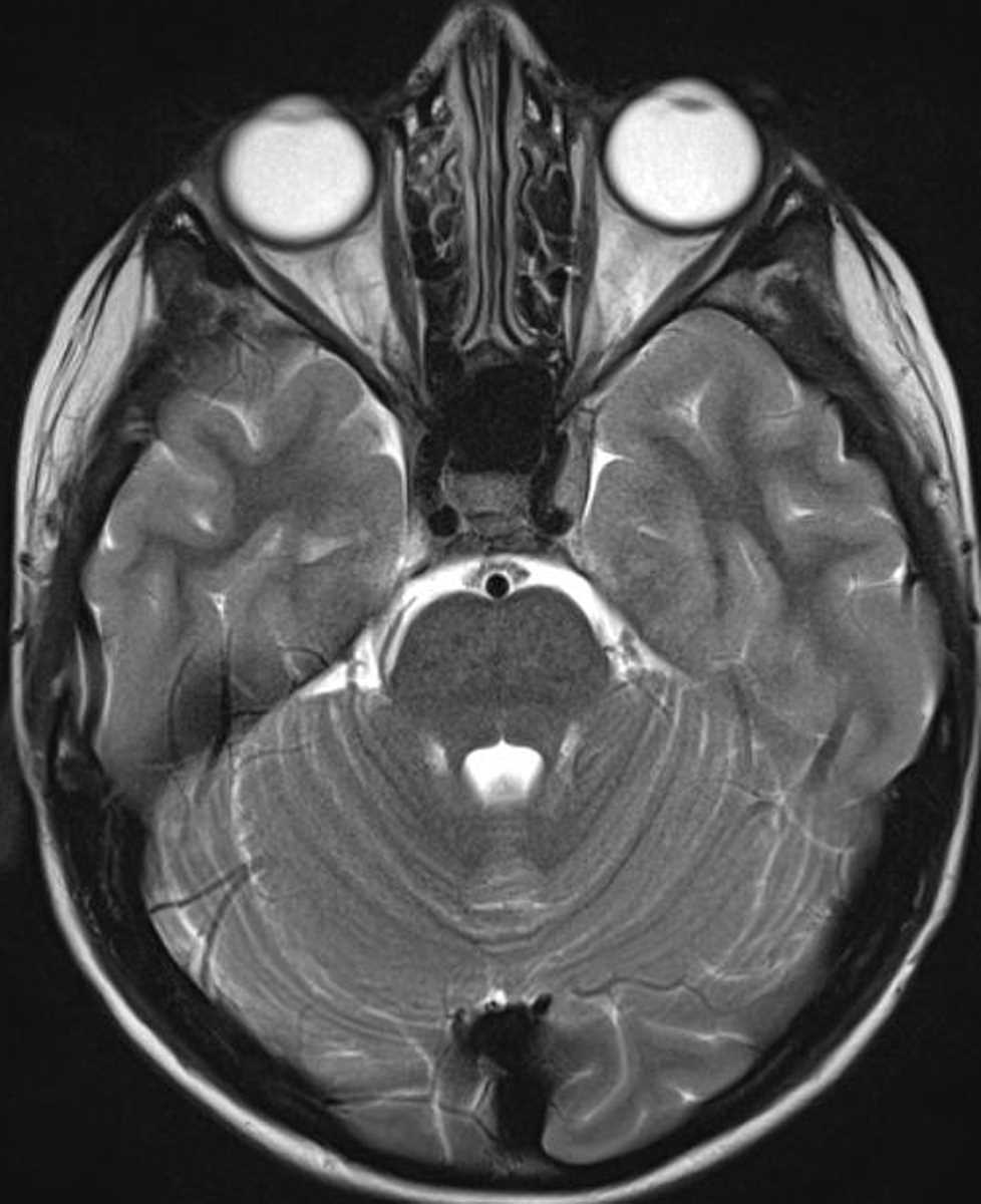 Burkitt Lymphoma (Skull Base) - CTisus CT Scan