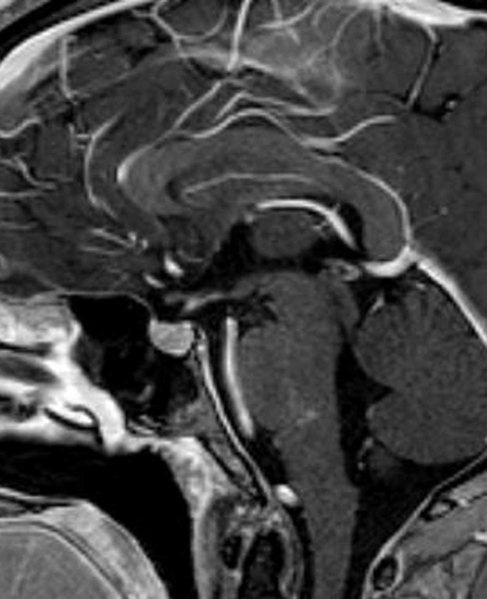 Capillary Telangiectasia - CTisus CT Scan