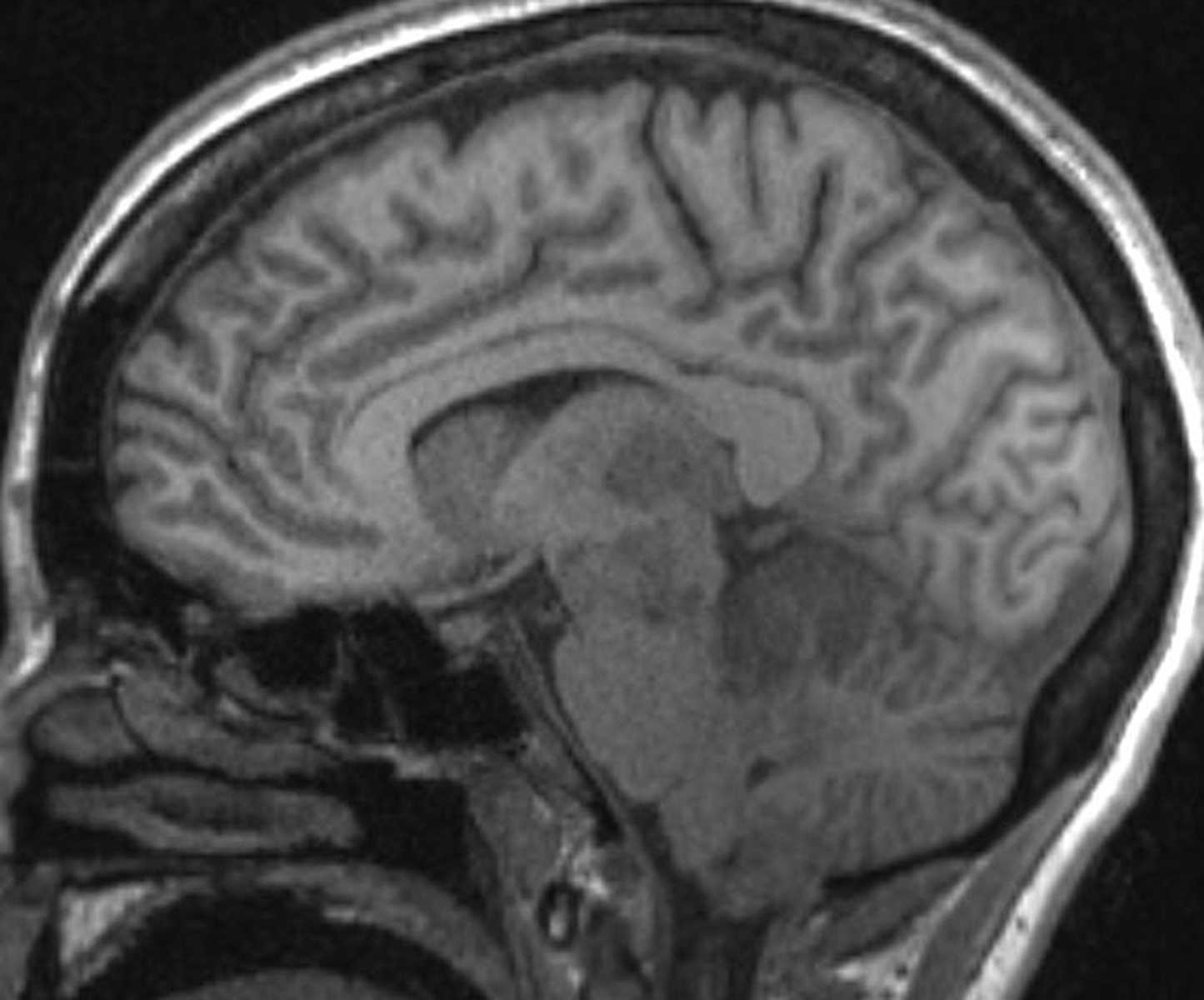 Infarction (Basilar) - CTisus CT Scan