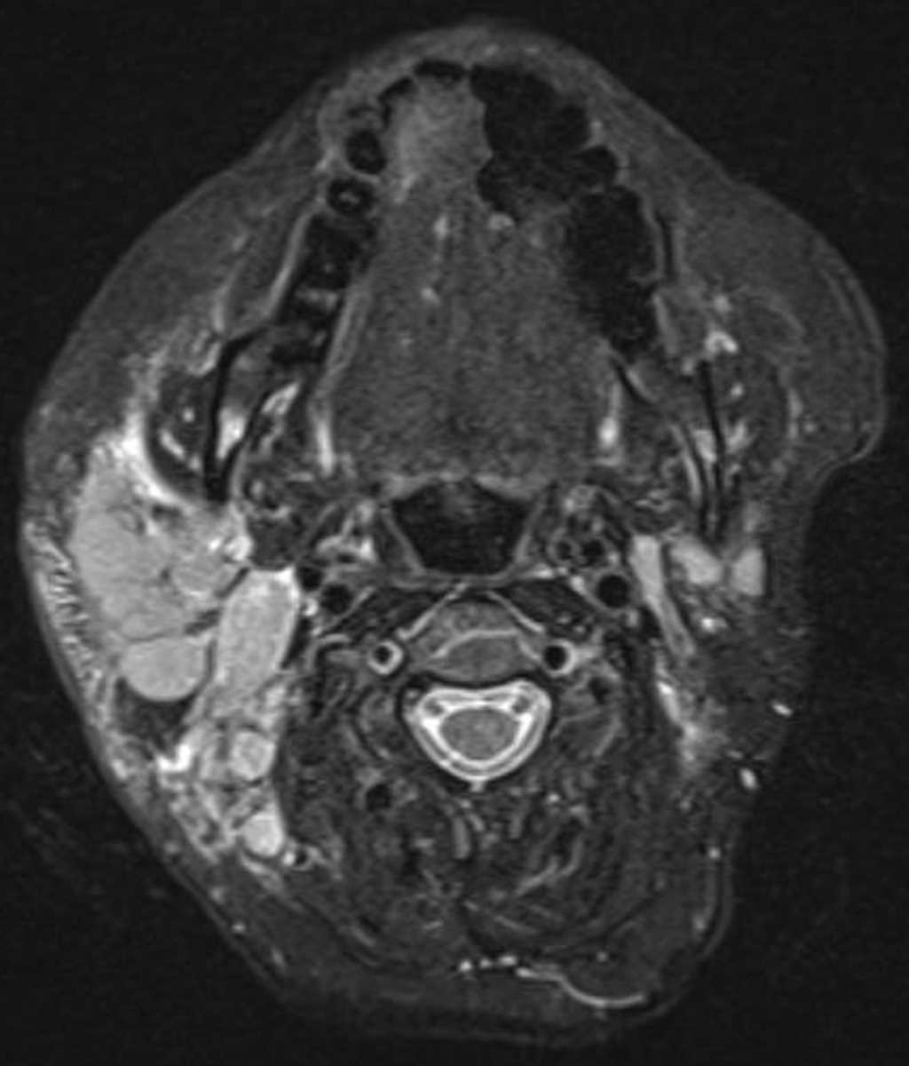 Lymphoma (Pharynx) - CTisus CT Scan