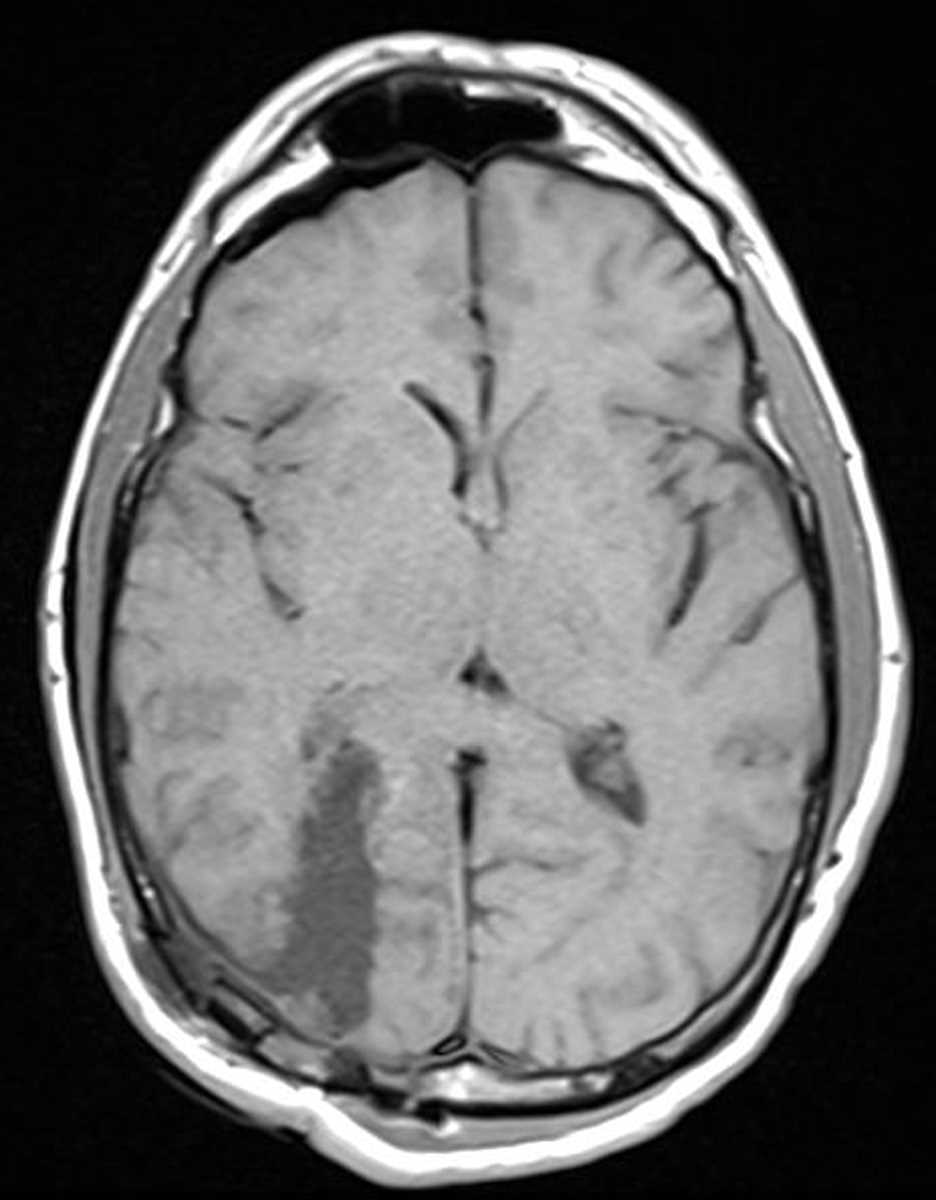 Infarction (Resection Cavity) - CTisus CT Scan