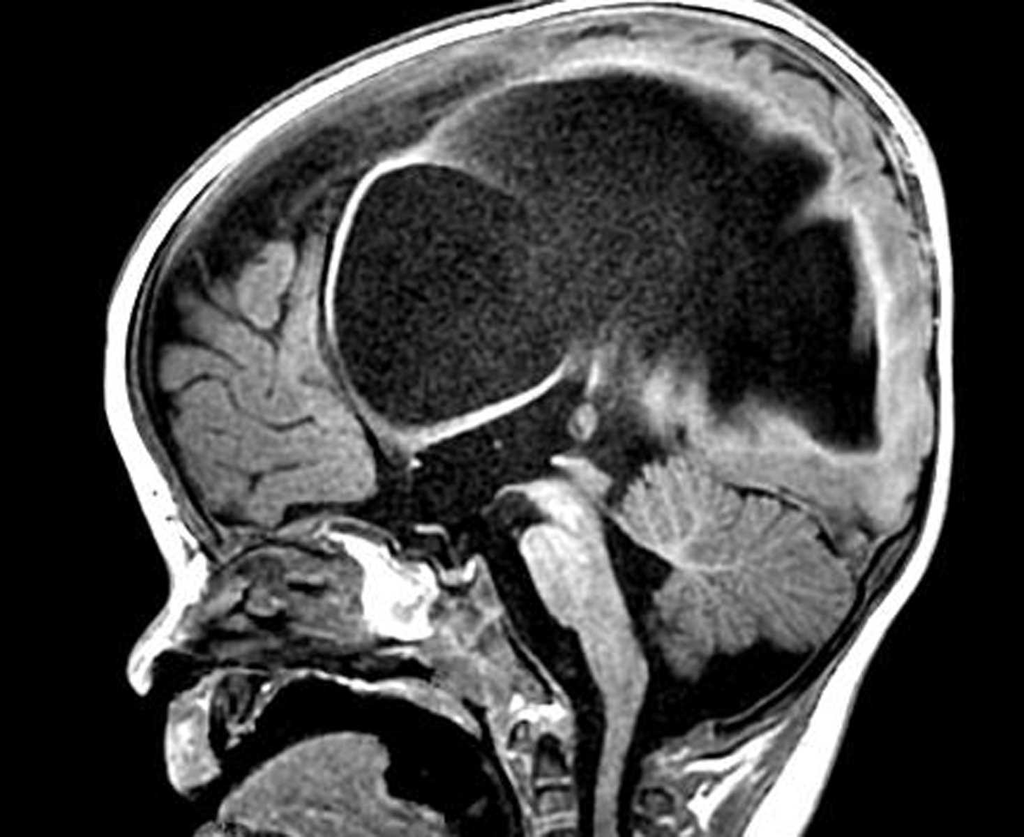 Third Ventriculostomy - CTisus CT Scan