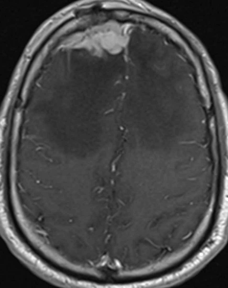 Tuberculous Meningitis - CTisus CT Scan