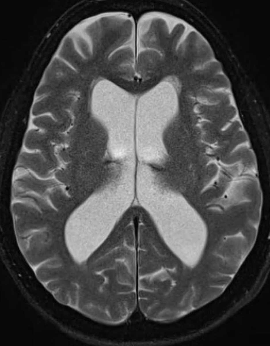 Aqueductal Stenosis - CTisus CT Scan