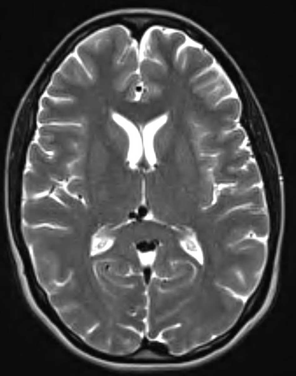 Arteriovenous Malformation - CTisus CT Scan