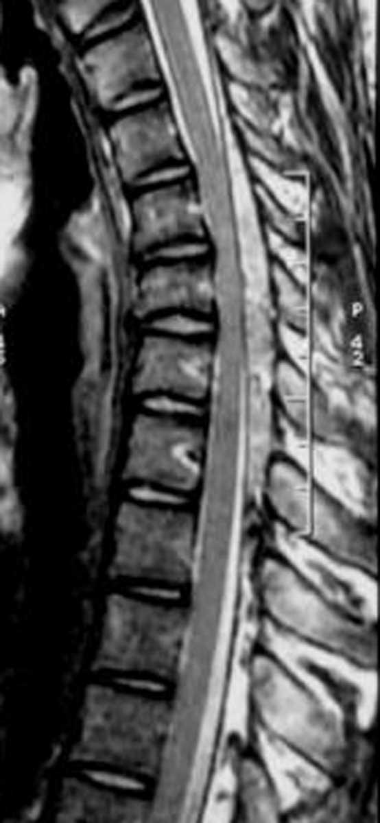 Hirayama Disease - CTisus CT Scan