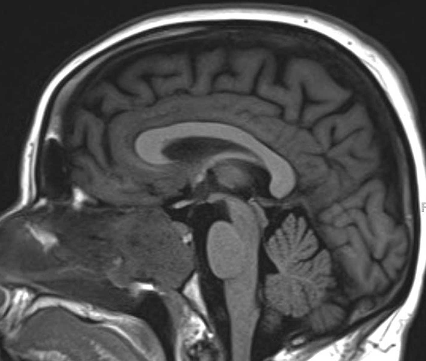 Inverting Papilloma - CTisus CT Scan