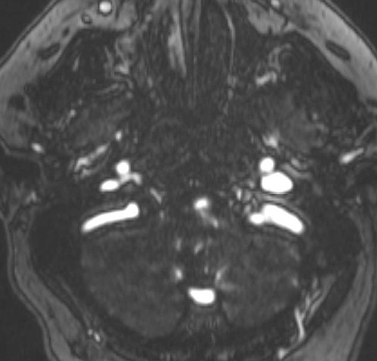 Occipital Sinus - CTisus CT Scan