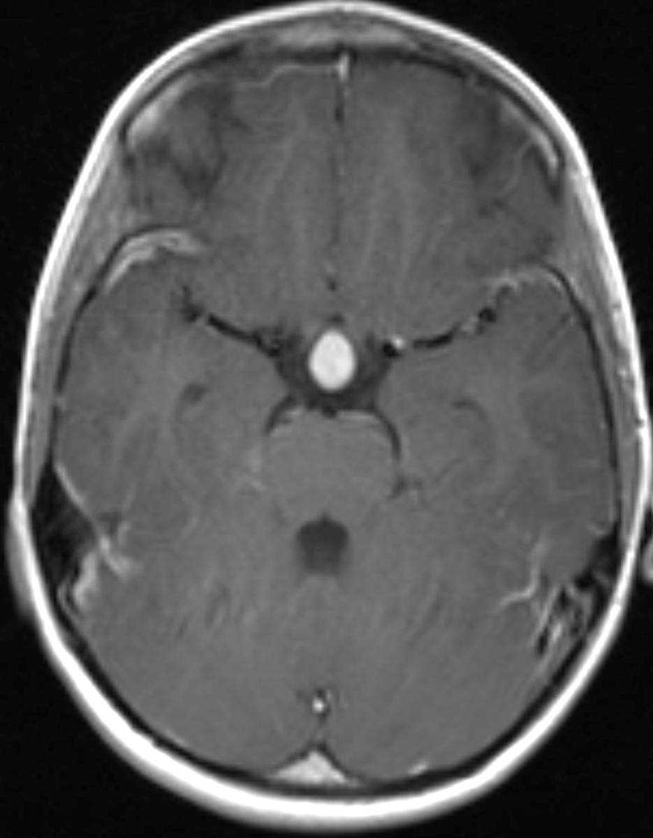 Langerhans Cell Histiocytosis of the Pituitary Gland - CTisus CT Scan