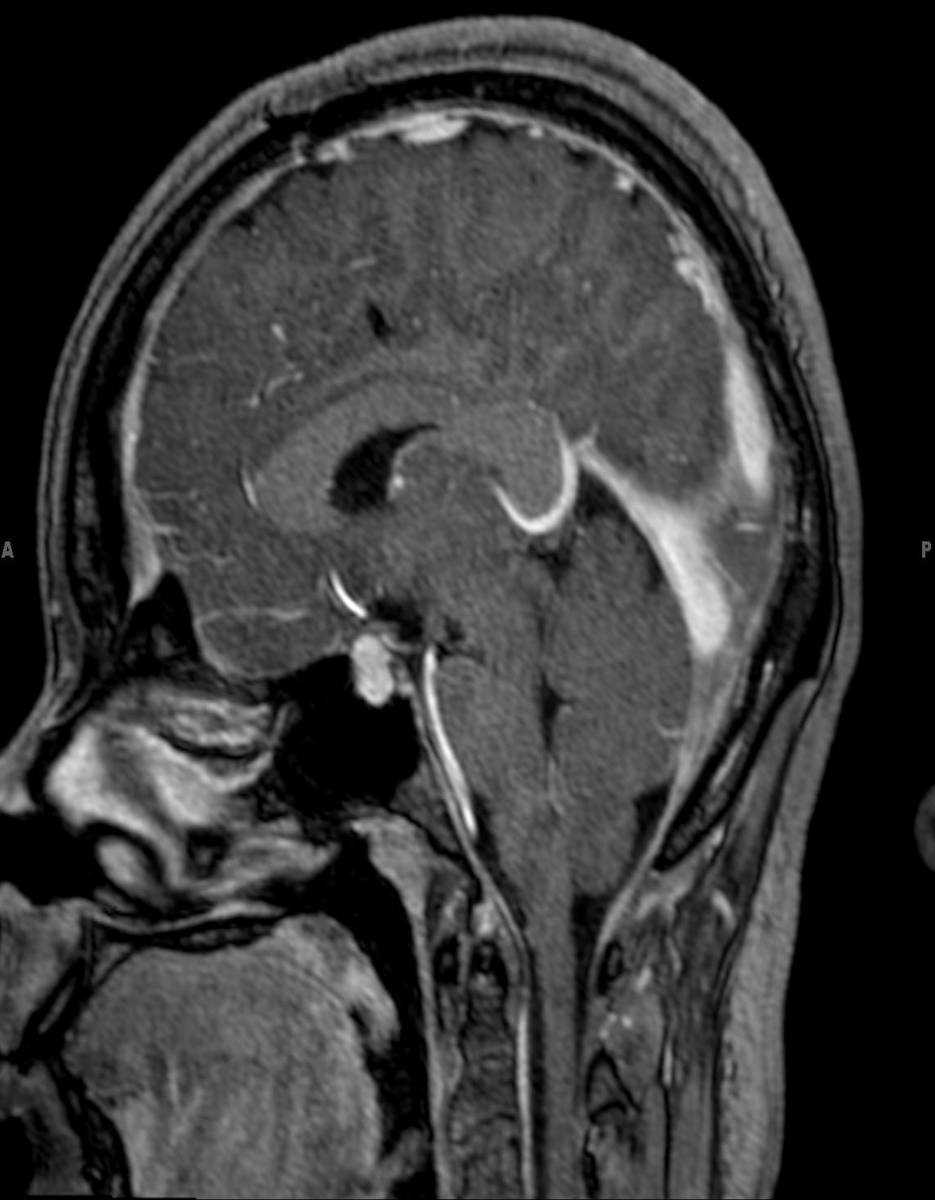 Intracranial Hypotension - CTisus CT Scan