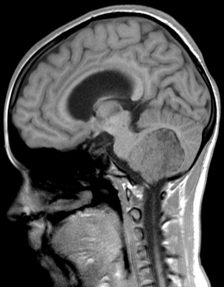 Choroid Plexus Papilloma - CTisus CT Scan