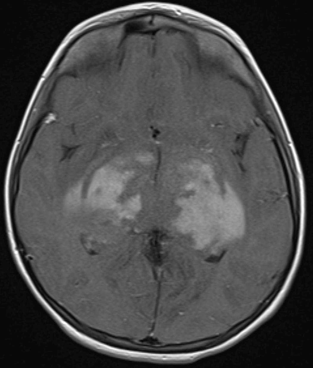 Optic Pathway Glioma - CTisus CT Scan