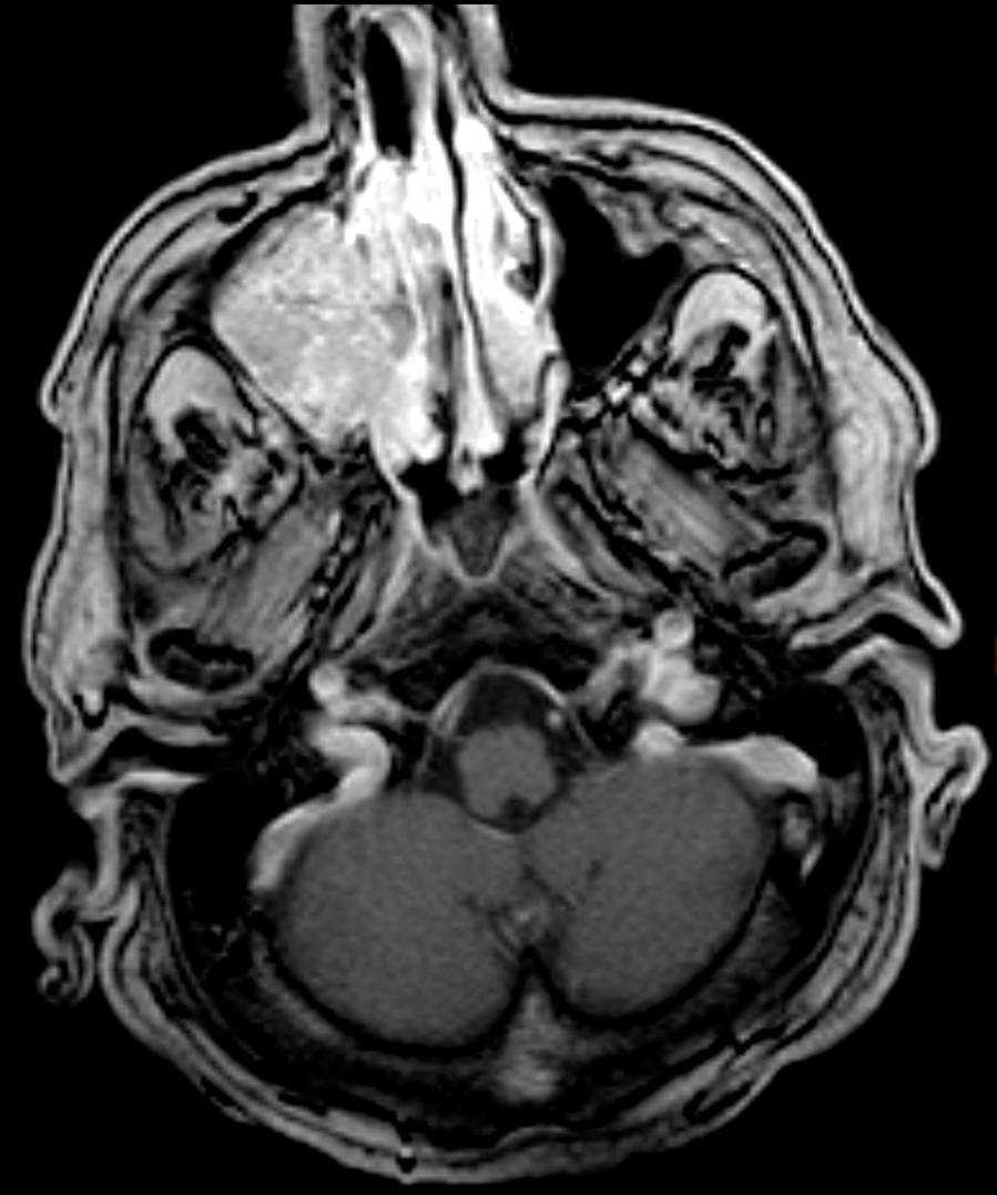 Inverted Papilloma - CTisus CT Scan