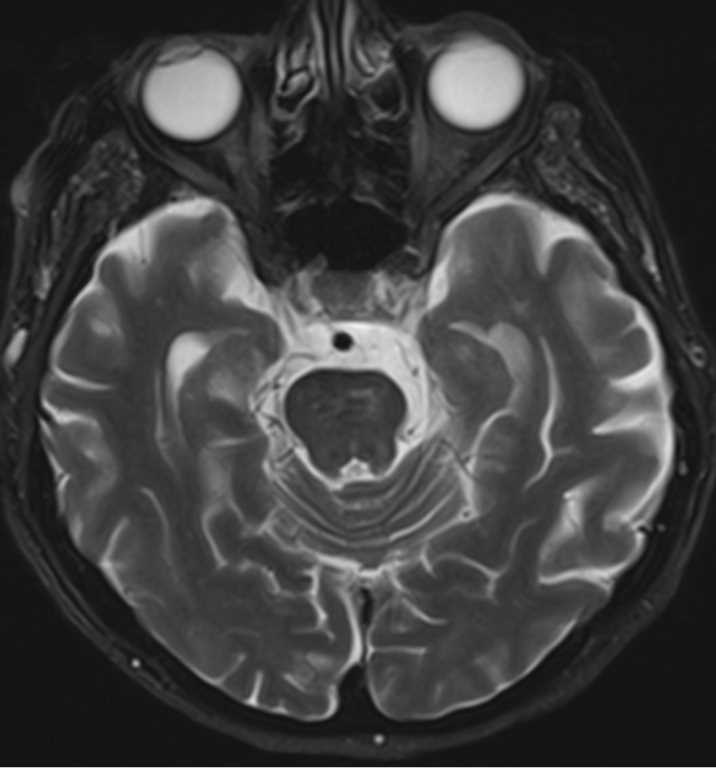Bilateral ICA Occlusion - CTisus CT Scan