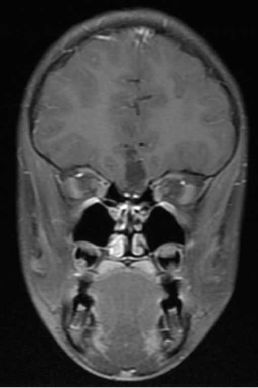 Planum Sphenoidale Dermoid - CTisus CT Scan