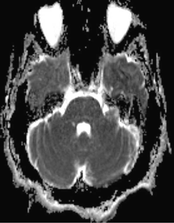 Cerebellopontine Angle Dermoid - CTisus CT Scan