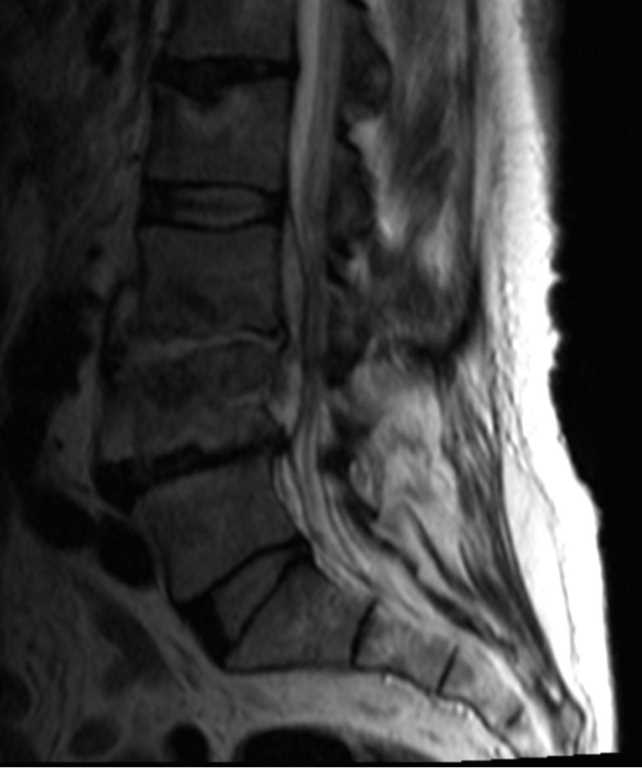 Discitis Osteomyelitis - CTisus CT Scan