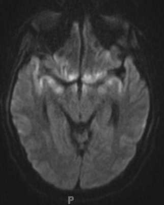 Herpes Encephalitis - CTisus CT Scan