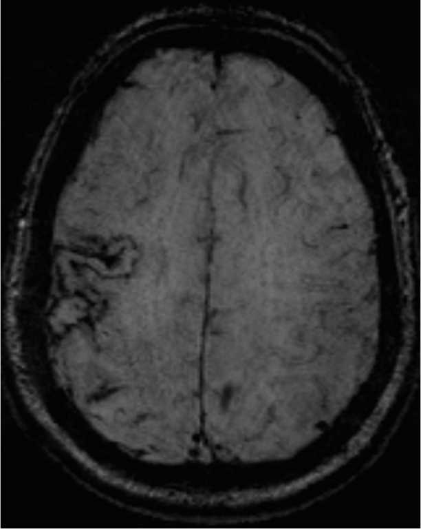 Laminar Necrosis - CTisus CT Scan