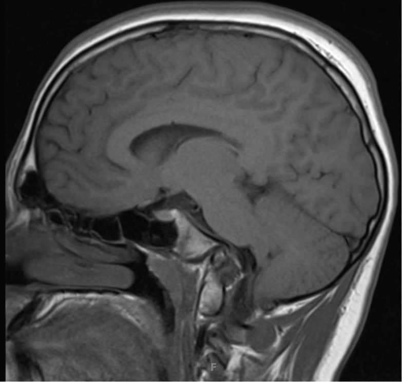 Basilar Impression - CTisus CT Scan