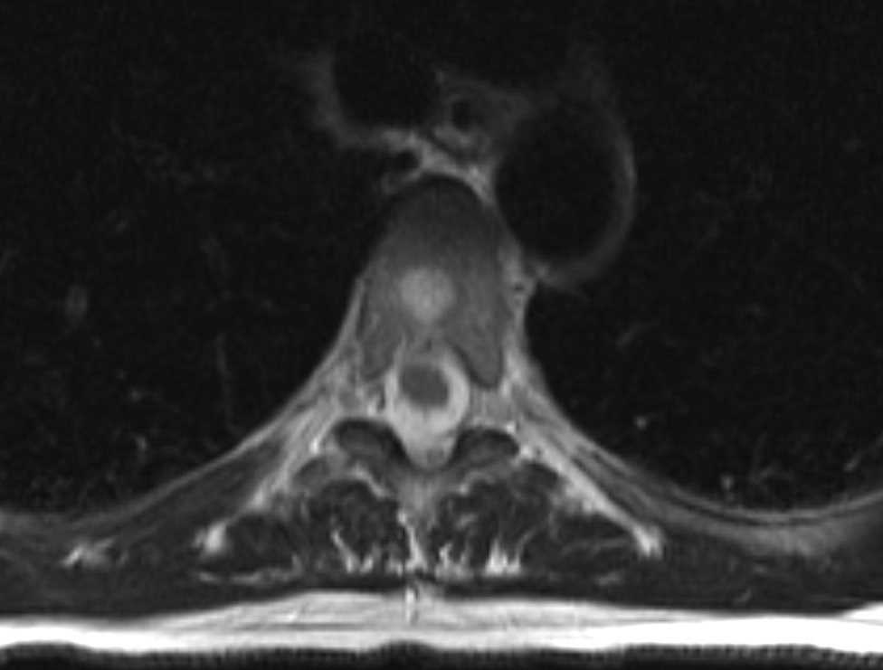 Typical and Atypical Hemangioma - CTisus CT Scan