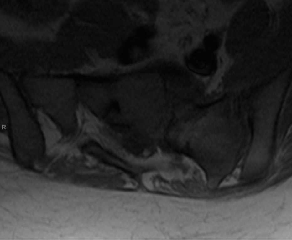 Tethered Cord - CTisus CT Scan