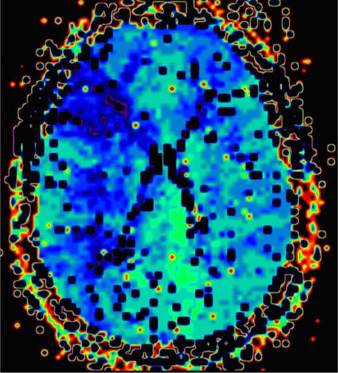 Moyamoya Syndrome Secondary to Sickle Cell Disease - CTisus CT Scan