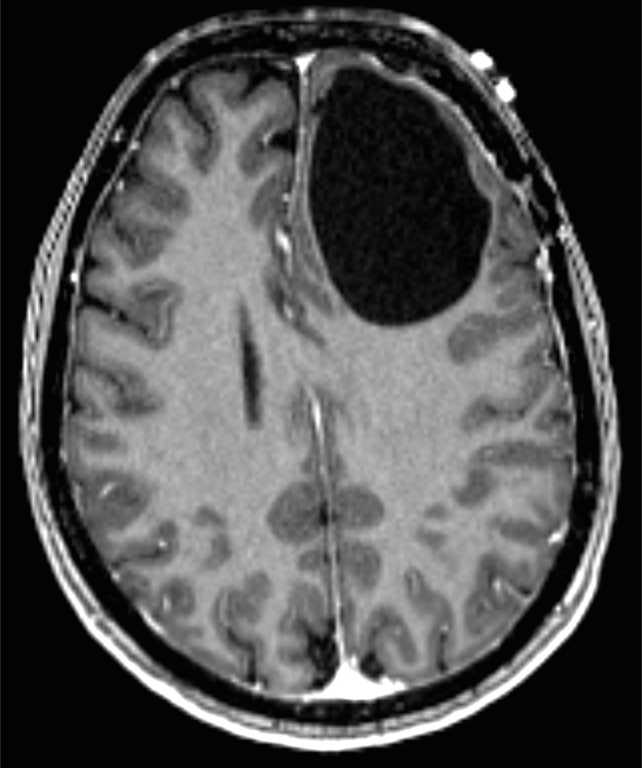 Neuroepithelial Ependymal Cyst - CTisus CT Scan