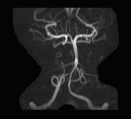 Vasospasm Secondary to Subarachnoid Hemorrhage - CTisus CT Scan