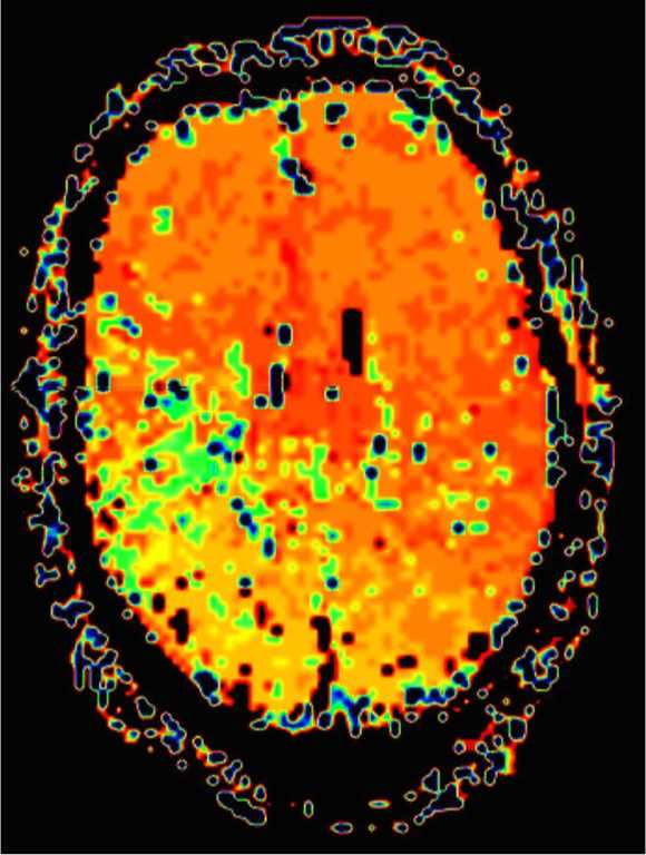 Basilar Tip Thrombosis (top of the basilar syndrome) - CTisus CT Scan