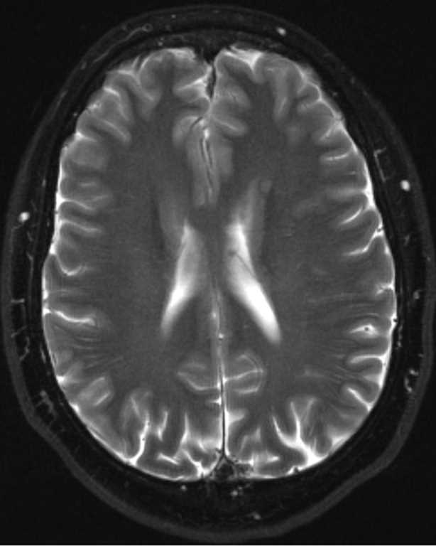 Grey Matter Heterotopia - CTisus CT Scan